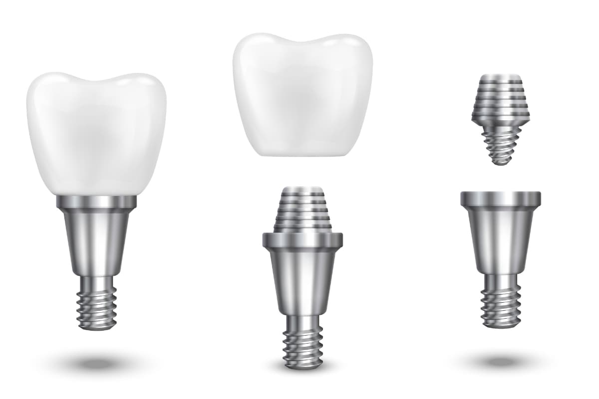 Tout ce qu’il faut savoir sur l’implant dentaire